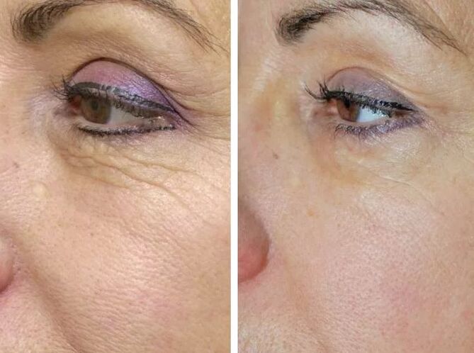 Láser de campo antes e despois